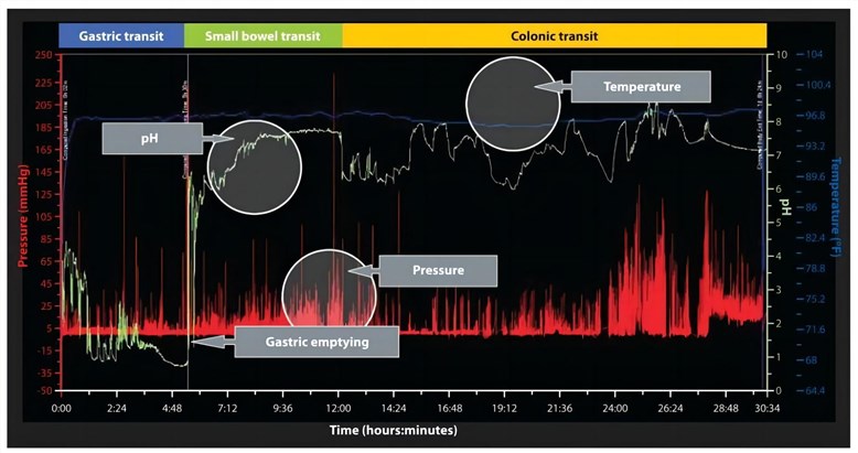 A sample motility graph showing data from a wireless motility capsule. (Saad, 2011)